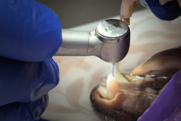 Endodontics III – Managing Complications Endodontics III – Managing Complications