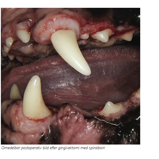 Användandet av helixformade spiralborrar kan dramatiskt förenkla gingivektomi. En av de stora fördelarna förutom den förkortade arbetstiden är den goda hemostasen! Efter utmätning av blödningspunkter med Goldman-Fox pincett (pocket marker) facetteras gingivan med hjälp av spiralborren. Hemostasen är omedelbar och endast en mycket lindrig blödning uppstår jämfört med konturering med hjälp av skalpell. Efterbehandling kan ske med lokalt med hemostatikum (t.ex. aluminiumklorid eller motsvarande) vid behov, och hyaluronsyregel (Aftaclear Gel) för patientens komfort. Efterbehandling med NSAID 3-5 dagar rekommenderas.