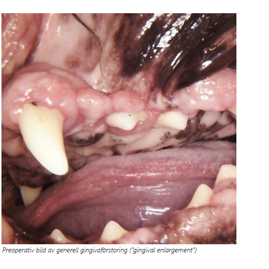 Gingivaförstoring (lokal eller generell) är oftast inflammatorisk men kan också orsakas av läkemedel, hypertrofi, hyperplasi eller neoplasi och påverkas av ärftliga faktorer. Den överväxande gingivan skapar falska s.k. pseudofickor där plack ansamlas, vilket förvärrar redan kronisk inflammation och disponerar för sekundär patologi.Gingivektomi hör till den enklare formen av parodontal kirurgi men kan icke desto mindre vara väldigt utmanande. Som en del i den normala tandrengöringsrutinen måste överflödig gingiva avlägsnas och normalt fickdjup återställas, ett moment som är både tidskrävande och som orsakar rikliga blödningar.